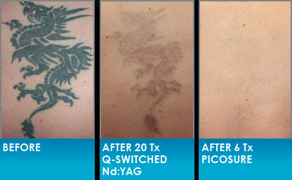 Tattoo Removal &amp; Fading | COCO Skin and Laser Clinic